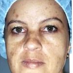 Cosmelan Before & After Patient #1514