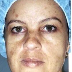 Cosmelan Before & After Patient #1514