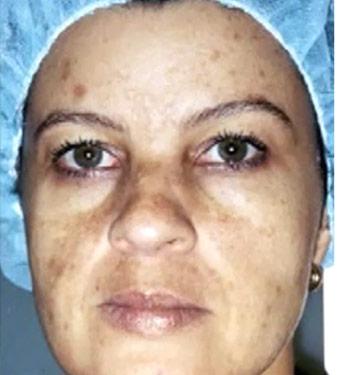 Cosmelan Before & After Patient #1514