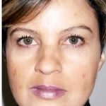 Cosmelan Before & After Patient #1514