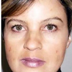 Cosmelan Before & After Patient #1514