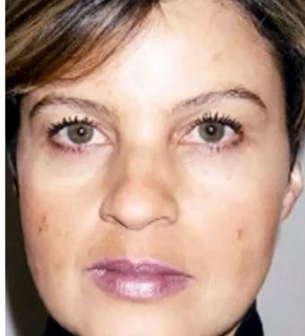 Cosmelan Before & After Patient #1514