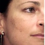 Cosmelan Before & After Patient #1516