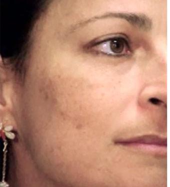 Cosmelan Before & After Patient #1516