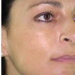 Cosmelan Before & After Patient #1516