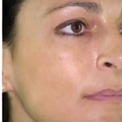 Cosmelan Before & After Patient #1516