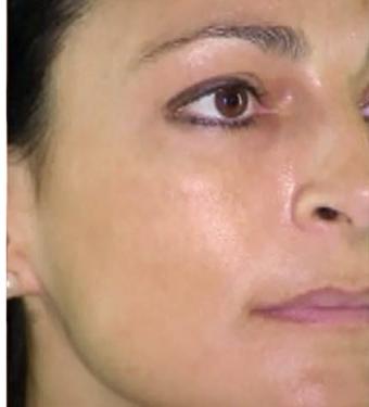 Cosmelan Before & After Patient #1516