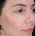 Cosmelan Before & After Patient #1518