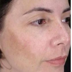 Cosmelan Before & After Patient #1518