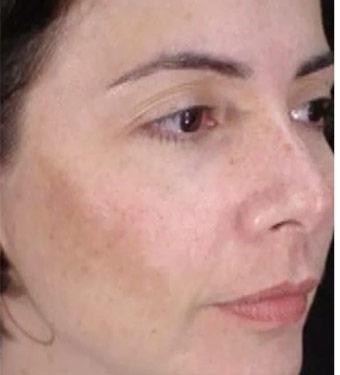 Cosmelan Before & After Patient #1518