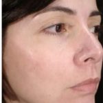 Cosmelan Before & After Patient #1518