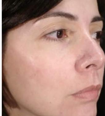 Cosmelan Before & After Patient #1518