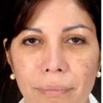 Cosmelan Before & After Patient #1520
