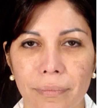 Cosmelan Before & After Patient #1520