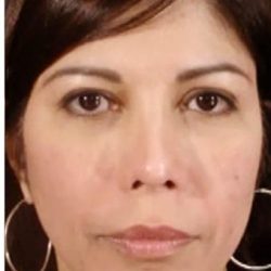 Cosmelan Before & After Patient #1520