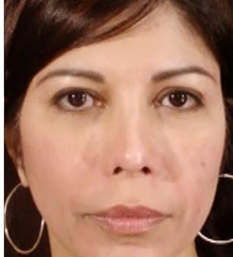 Cosmelan Before & After Patient #1520
