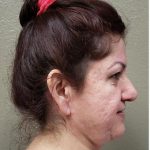 Face Lift Before & After Patient #1253