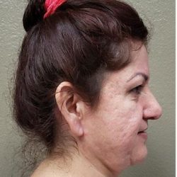 Face Lift Before & After Patient #1253