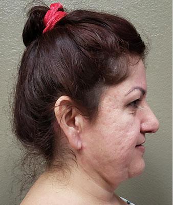 Face Lift Before & After Patient #1253