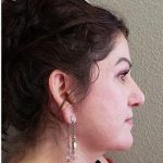 Face Lift Before & After Patient #1253