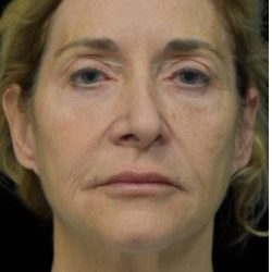 Face Lift Before & After Patient #1254