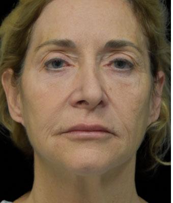Face Lift Before & After Patient #1254