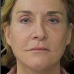 Face Lift Before & After Patient #1254