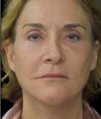 Face Lift Before & After Patient #1254