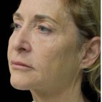 Face Lift Before & After Patient #1254
