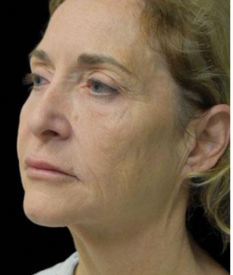 Face Lift Before & After Patient #1254