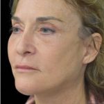 Face Lift Before & After Patient #1254