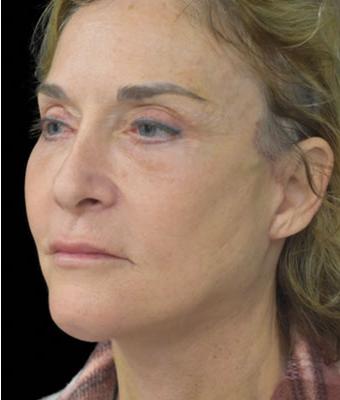 Patient #1254 Face Lift Before and After Photos Santa Ana - Plastic