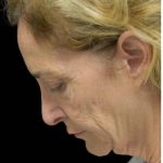 Face Lift Before & After Patient #1254