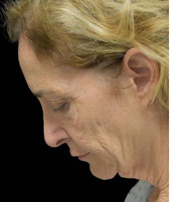 Face Lift Before & After Patient #1254