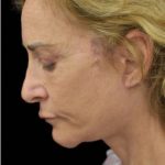 Face Lift Before & After Patient #1254
