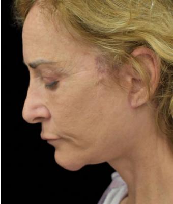 Face Lift Before & After Patient #1254