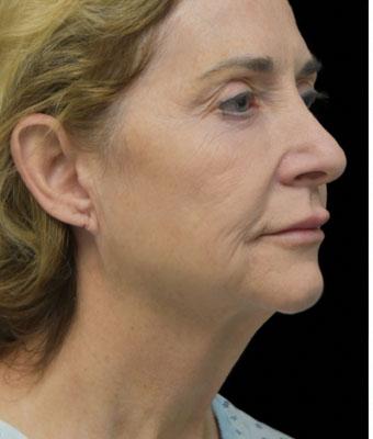 Face Lift Before & After Patient #1254