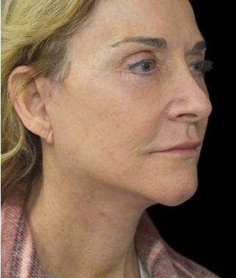 Face Lift Before & After Patient #1254