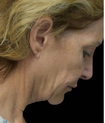 Face Lift Before & After Patient #1254