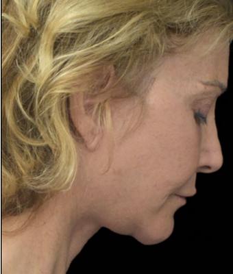 Face Lift Before & After Patient #1254