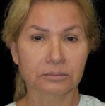 Face Lift Before & After Patient #1255
