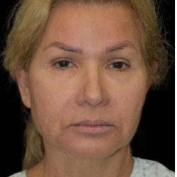 Face Lift Before & After Patient #1255