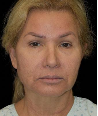 Face Lift Before & After Patient #1255