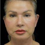 Face Lift Before & After Patient #1255