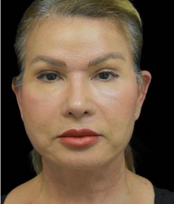 Patient #1255 Face Lift Before and After Photos Santa Ana - Plastic