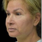 Face Lift Before & After Patient #1255