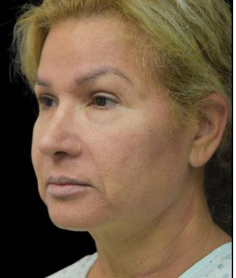 Face Lift Before & After Patient #1255