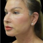 Face Lift Before & After Patient #1255