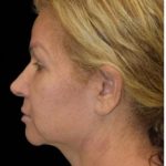 Face Lift Before & After Patient #1255