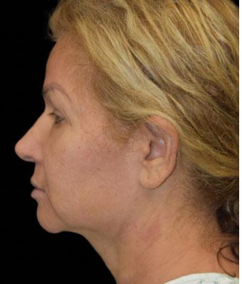 Face Lift Before & After Patient #1255
